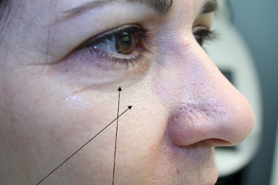 Before, Inner cheek Hollows and Under Eye Volume Loss