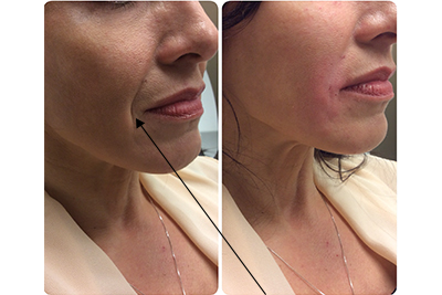 Before and After Restylane Procedure