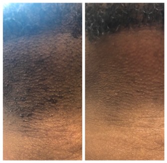 Before and After Laser Hair Removal